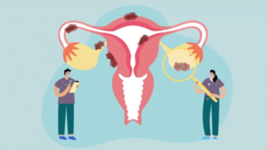 Endometriosis
