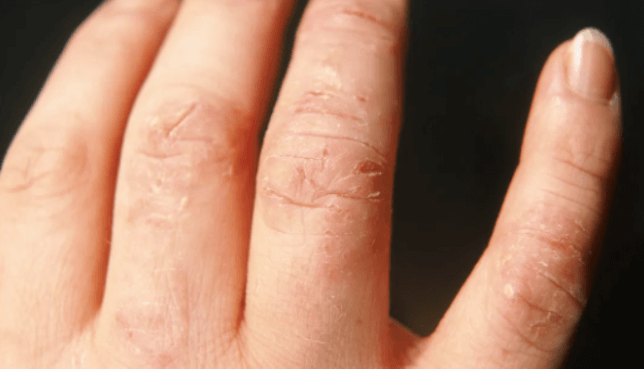 Skin Disorders That Causes Eczema