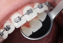 Orthodontics for Adults in Las Vegas Is on the Rise