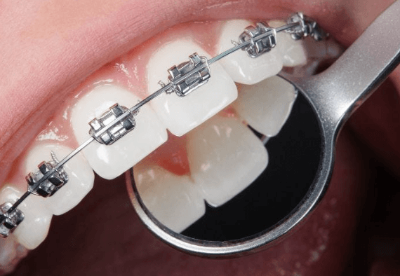 Orthodontics for Adults in Las Vegas Is on the Rise