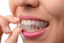 How the Invisalign Procedure Works with the Help of an Orthodontist in Surrey