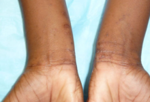 Permethrin 5% Cream: Your Complete Guide to Treating Scabies Effectively