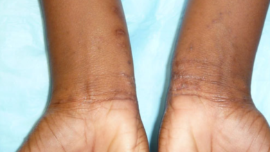 Permethrin 5% Cream: Your Complete Guide to Treating Scabies Effectively