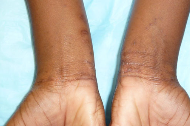 Permethrin 5% Cream: Your Complete Guide to Treating Scabies Effectively