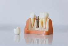 Advances in Implant Dentistry That Help Patients Recover Faster