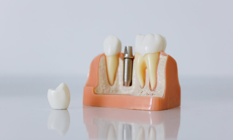 Advances in Implant Dentistry That Help Patients Recover Faster