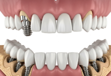 Comprehensive Full-Arch Restoration Through Six Implant Integration