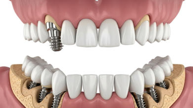 Comprehensive Full-Arch Restoration Through Six Implant Integration